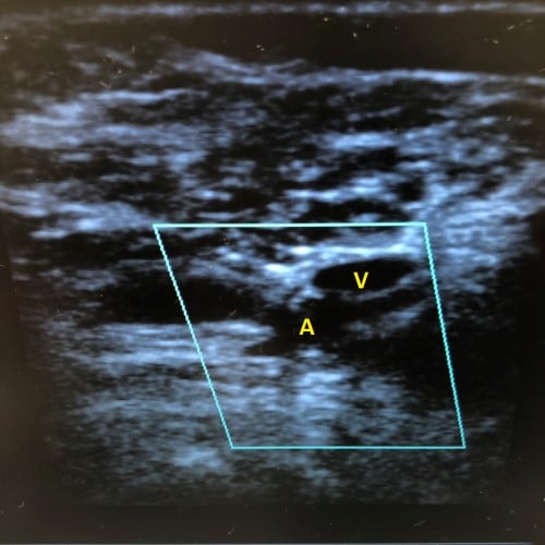 47-6 Popliteal Artery - Figure 2.jpg