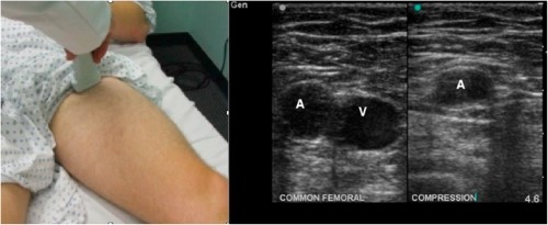 47-6 Popliteal Artery - Figure 5.jpg