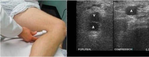 47-6 Popliteal Artery - Figure 6.jpg