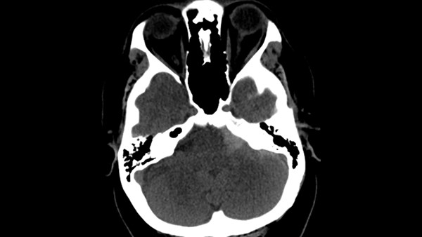 Subarachnoid hemorrhage Radiology Reference Article