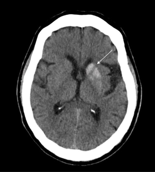 NHH Case Report - Figure 1.jpg