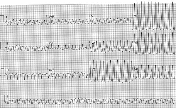 48-1 ECG Challenge - VT storm COVID.jpg