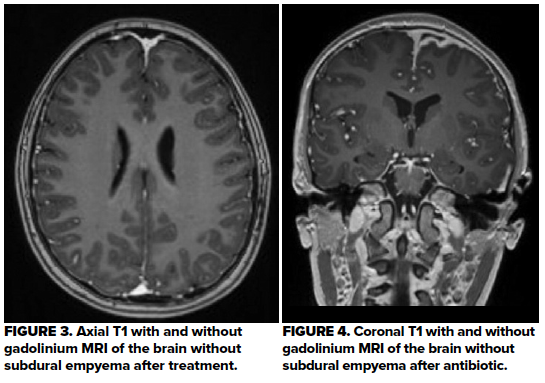 48-1 Pediatric subdural empyema Fig 3-4.png