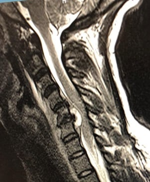 48-1 Spinal Epidural Abscess.jpg