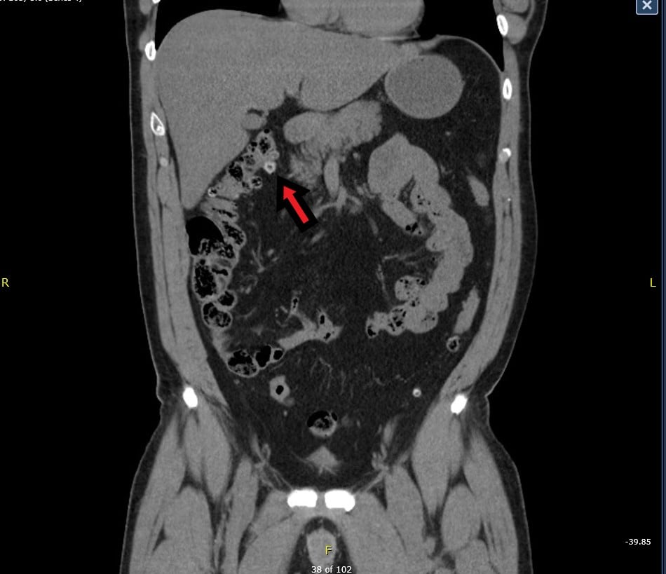 48-2 Appendagitis.jpg