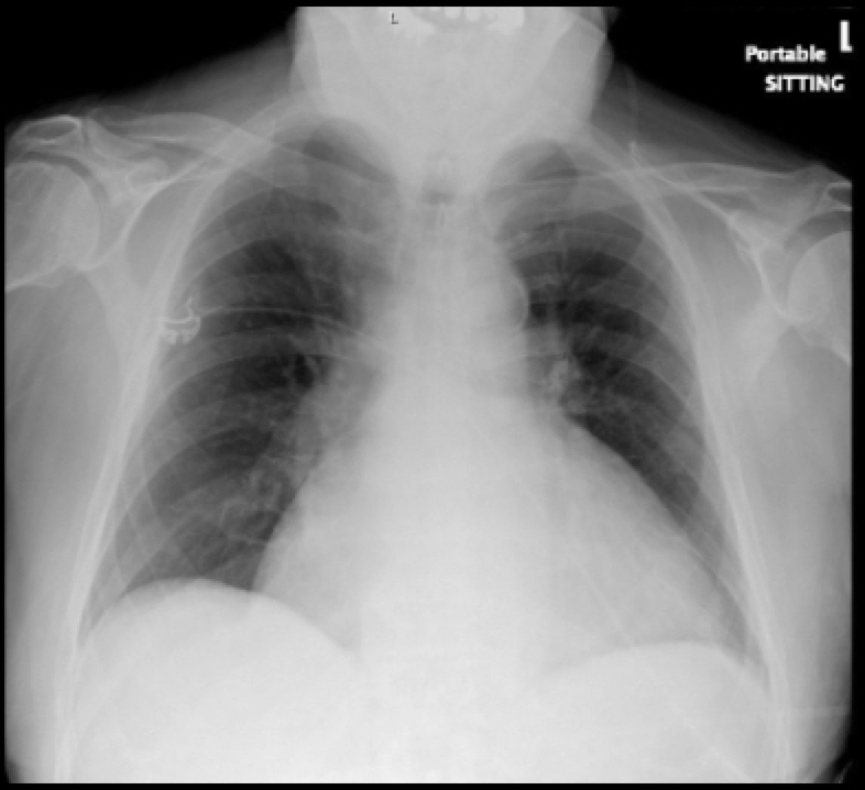 48-2 Hemopericardium - cxr-supine-ap Fig 1.jpg