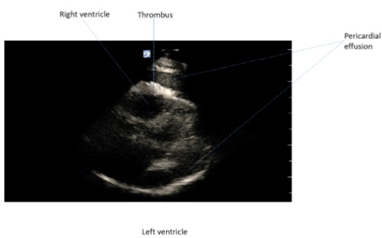 48-2 Hemopericardium Fig 2.jpg