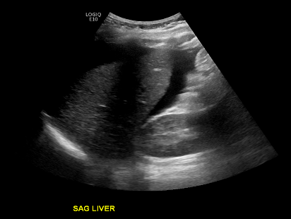 48-2 Hemoperitoneum Figure 1 .png