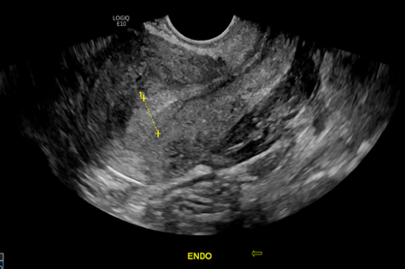 48-2 Hemoperitoneum Figure 2.png