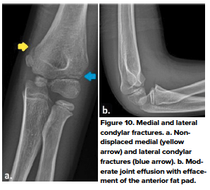 48-2 Ped Elbow 10.png