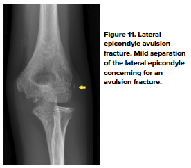 48-2 Ped Elbow 11.png