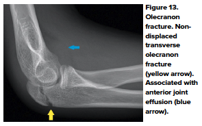 48-2 Ped Elbow 13.png