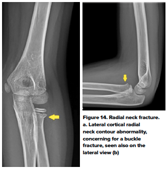 48-2 Ped Elbow 14.png