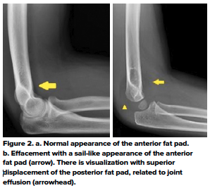 48-2 Ped Elbow 2.png