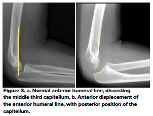 48-2 Ped Elbow 3.png