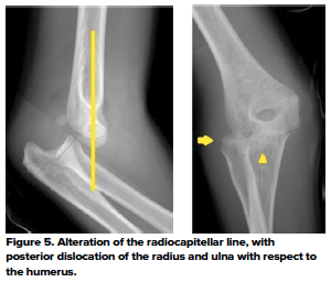 48-2 Ped Elbow 5.png