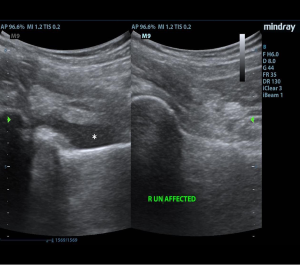 48-2 Ped Gonococcal Hip Fig 2.png