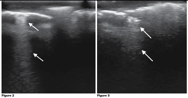 48-2 Subcutaneous Emphysema 2-3 .png