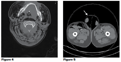 48-2 Subcutaneous Emphysema 4-5.png