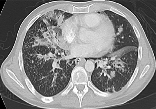 48-3 Excipient Lung Disease.png