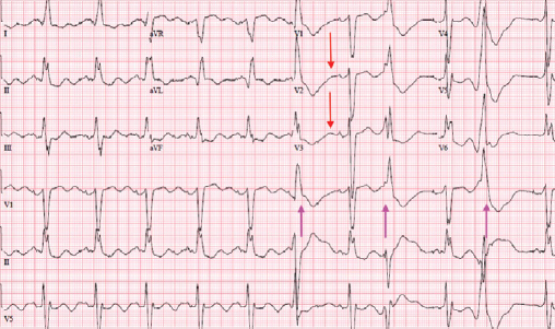 48-3 Hypokalemia Figure 1.png