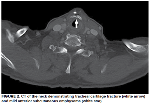 48-3 Laryngeal Injury Figure 2.png