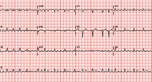 48-3 Lyme Pericarditis EKG.png