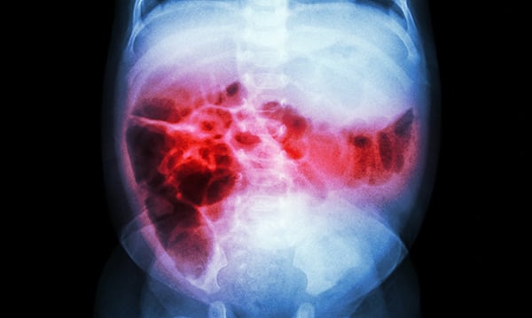Acute Abdominal Pain in a Child