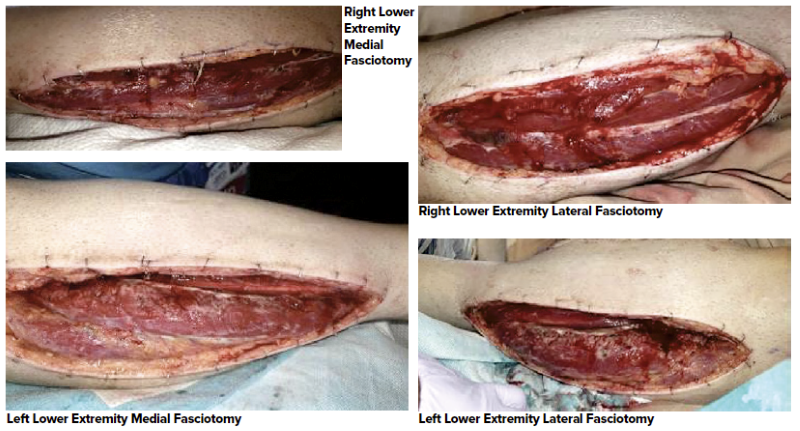 48-4 Compartment Syndrome Figures 1-4.png