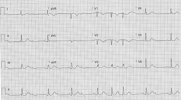 48-4 ECG Challenge - Mobitz I.jpg