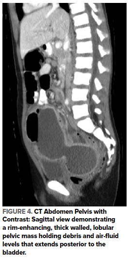 48-4 Intraabdominal Abscess Fig 4.png