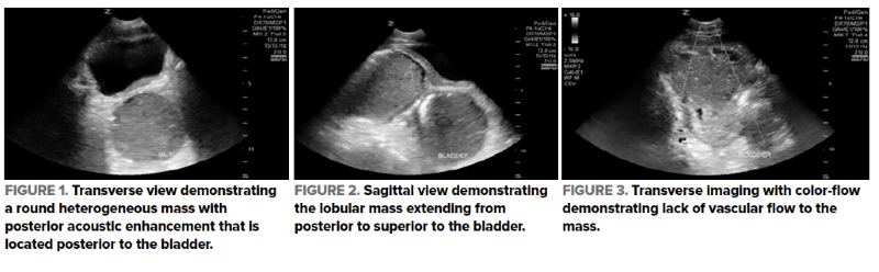 48-4 Intraabdominal Abscess.png