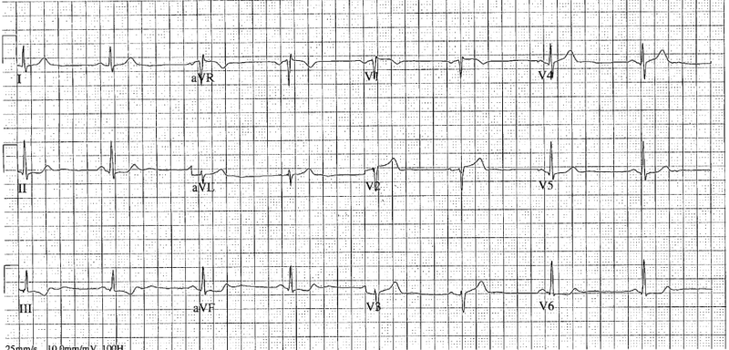 48-4 LAD Lesion - ECG 2.png