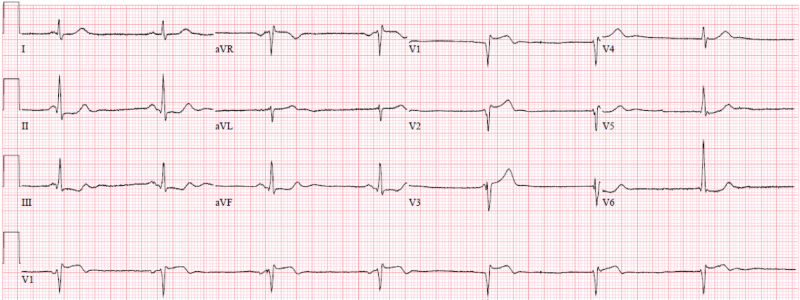 48-4 LAD Lesion - ECG 3.png