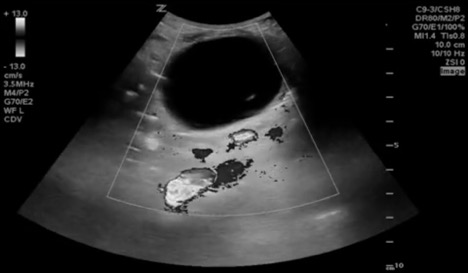 48-4 Pediatric Acute Abdomen Fig 4.jpeg