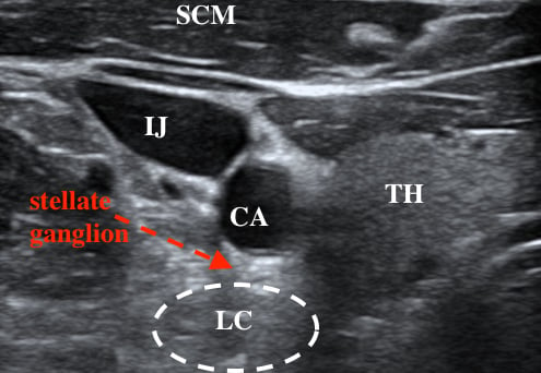 48-4 Stellate Ganglion Fig 1.jpeg