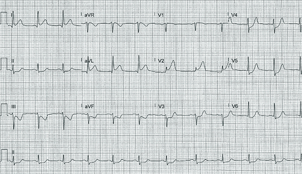 48-5 ECG Challenge - High lateral-01.jpg