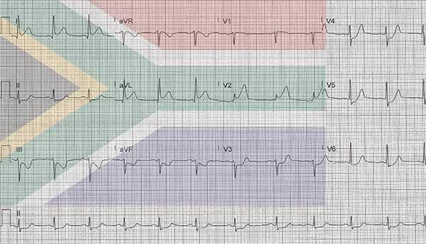 48-5 ECG Challenge - High Lateral MI flag sign-01.jpg