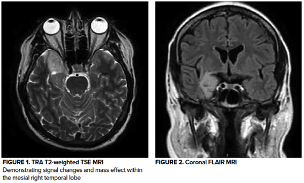 48-5 Temporal Lobe Epilepsy Fig 1-2.png