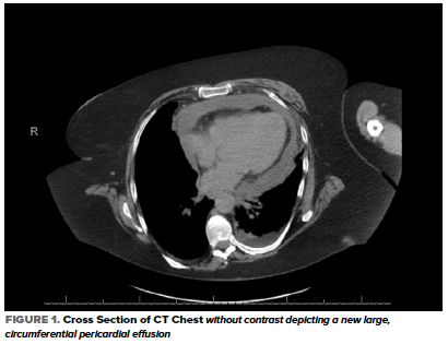 48-6 COVID Pericardial Effusion Fig 1.png