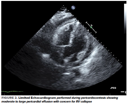 48-6 COVID Pericardial Effusion Fig 2.png