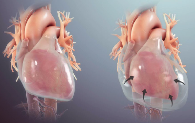 48-6 COVID Pericardial Effusion.png