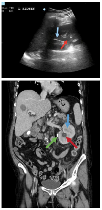 48-6 Emphysematous Pyelonephritis.png