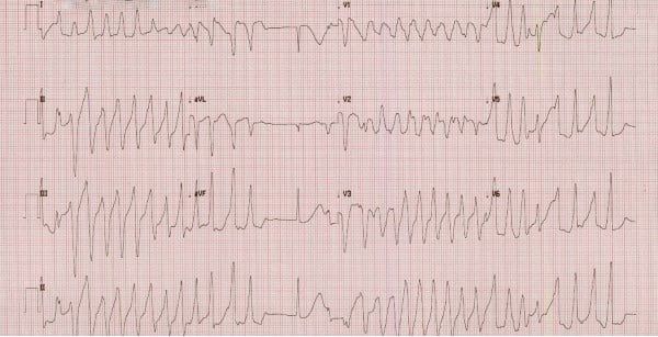 48-6 Torsades - Figure1.jpg