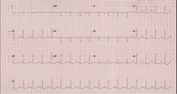 48-6 Torsades - Figure2.jpg