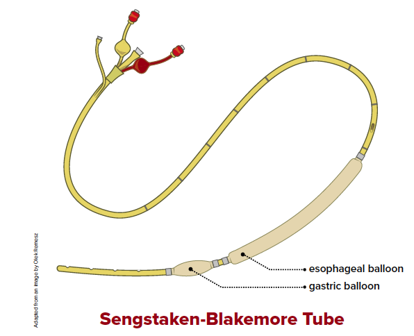 49-1 Balloon Tamponade for Rectal Bleed.png