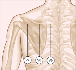 49-1 ECG Challenge - Posterior MI-01.png