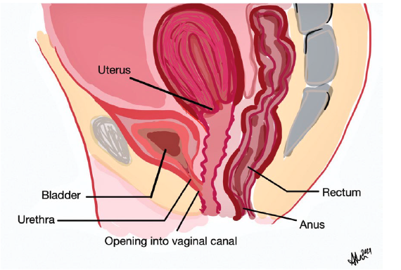 49-1 Female Hypospadias.png