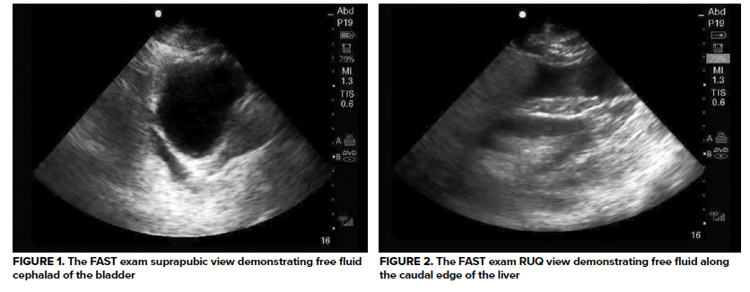 49-1 Intraperitoneal Bladder Rupture.png