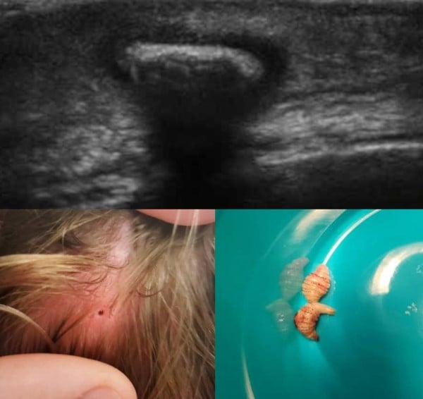 Crawling In My Skin: An Ultrasound Teaching Case EMRA